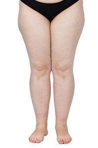 legs obese. Weight problems. trouble walking. pÅ?askosotopie, valgus knee